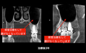 root-canal-after