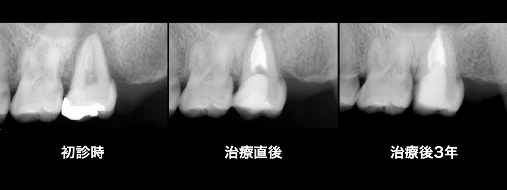 root-canal_case_img01