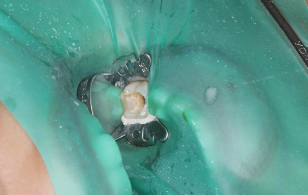 rubber-dam_img02