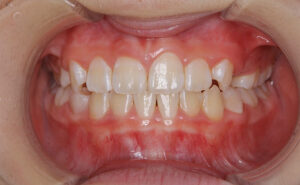 preortho-after