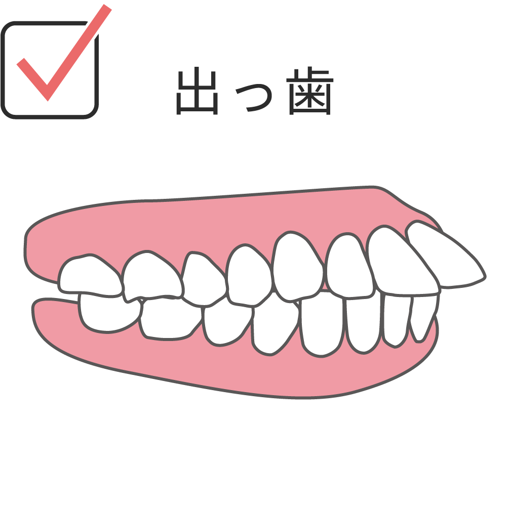overbite
