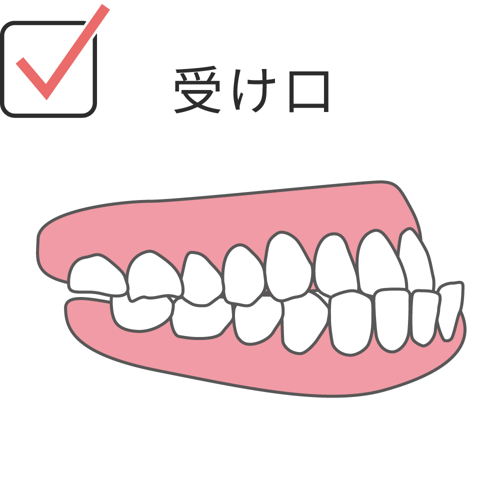 underbite