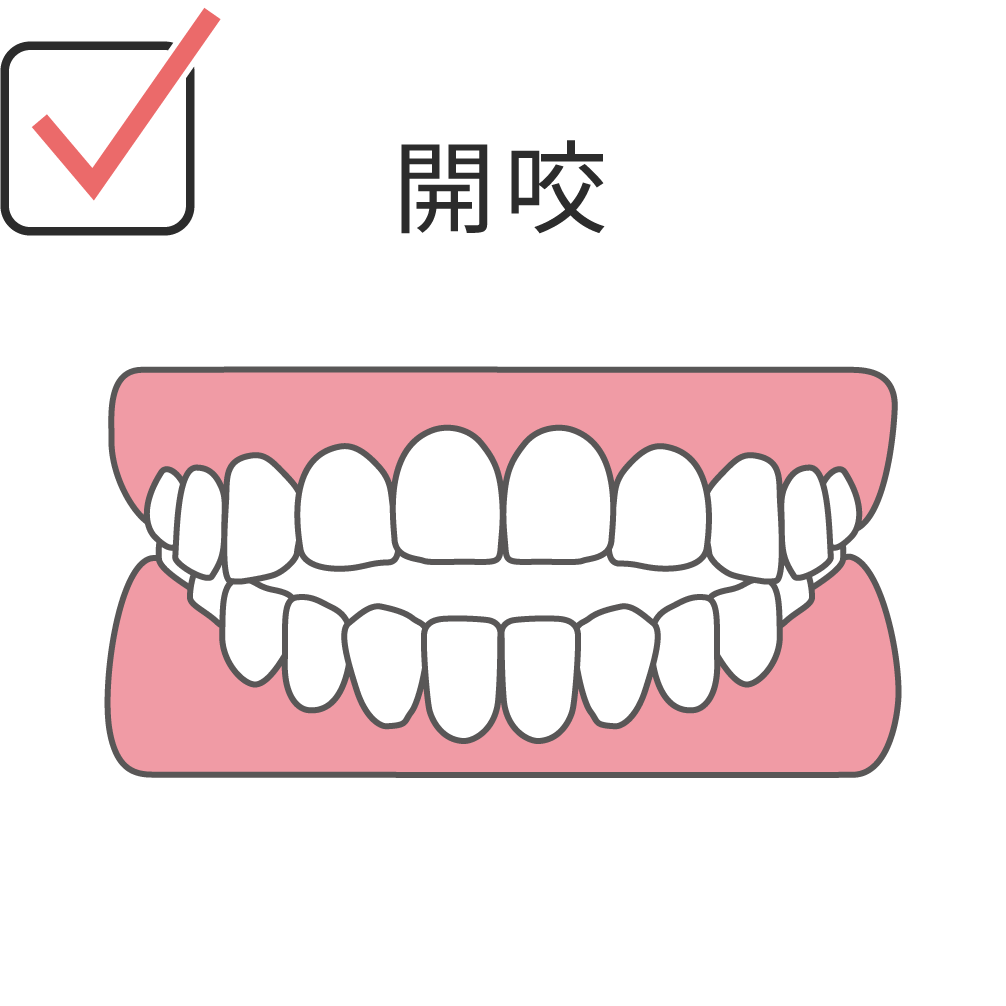 open-bite