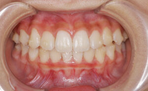 invisalign-first-after