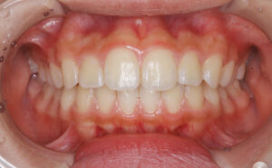 invisalign-first-after